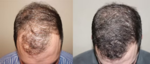 non-surgical hair loss treatment New Jersey