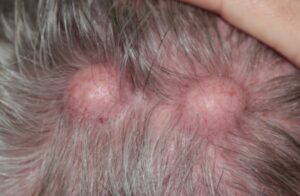 wart treatment mission Viejo CA