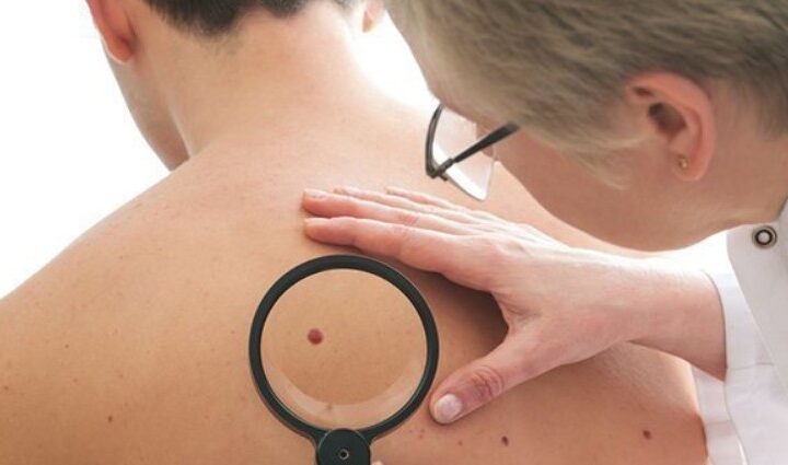 lipoma treatment Irvine CA