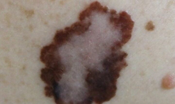 lipoma treatment Orange CA