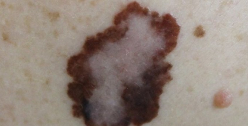 lipoma treatment Orange CA