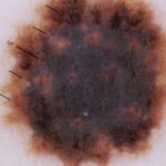 cyst treatment costa mesa ca