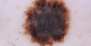 cyst treatment costa mesa ca