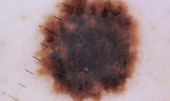 cyst treatment costa mesa ca