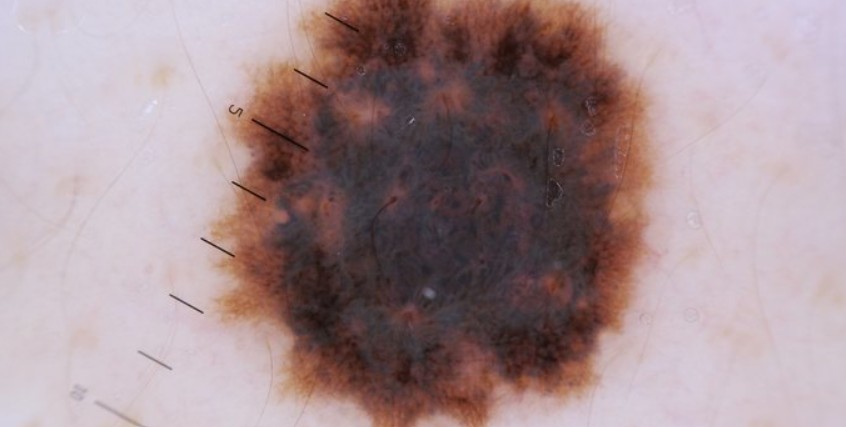 cyst treatment costa mesa ca